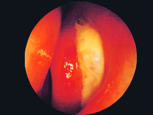 Acute-Maxillary-Sinusitis