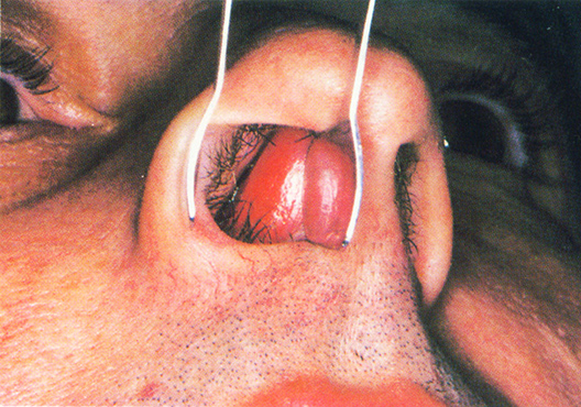 Deviated Nasal Septum