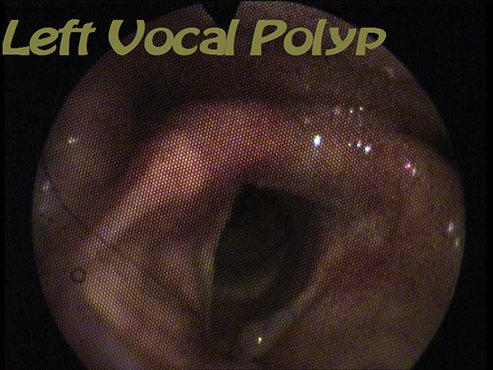 Lt. Vocal Polyp