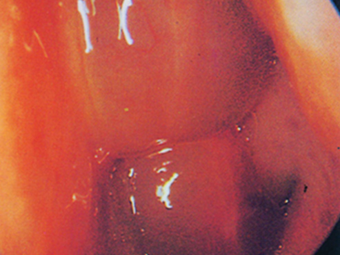 Nasal-Polyps