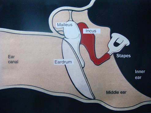 Tympanoplasty Surgery