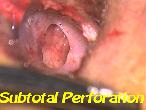 Subtotal-Perforation
